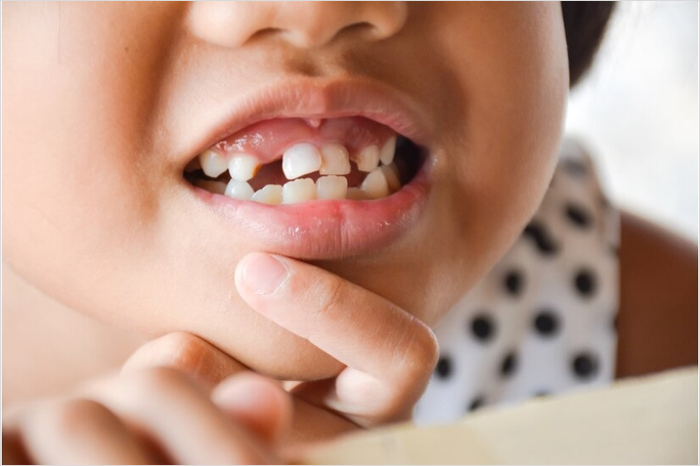 치아 일부가 검게 변한 경우: 충치 의심