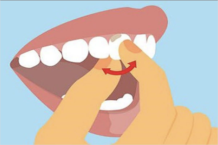 아이의 흔들리는 치아: 집에서 안전하게 치아를 빼는 방법